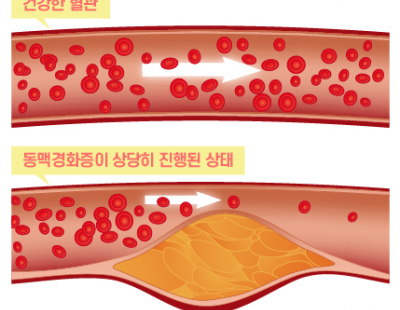 ‘나쁜 콜레스테롤’ 수치 높이는 ‘이 단백질’, 염증도 악화시킨다