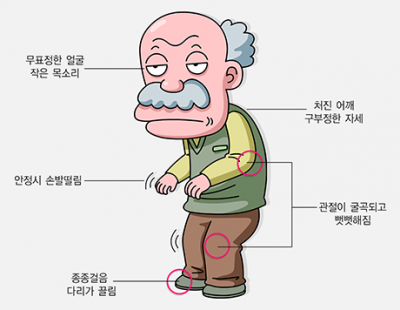 잠꼬대 심해지고 냄새 맡기 어려워졌다면··· 혹시 ‘이 병’일까?