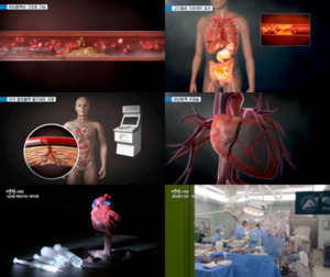 EBS '명의' 심근경색-협심증 증상과 위험 요인, 수술법과 치료법