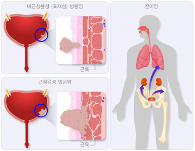 고령의 흡연자, 통증 없는데도 혈뇨 나온다면··· ‘이 암’ 의심해봐야