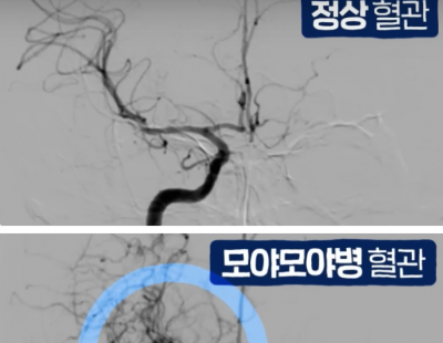 머릿속 연기가 피어오르듯··· 뇌혈관 이상 부르는 ‘모야모야병’ 악화 원인 찾았다