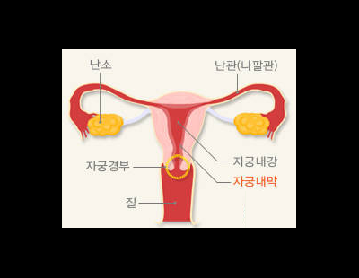 여성 건강 위협하는 자궁암··· 비정상적인 출혈 보일 땐 의심해봐야