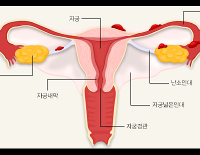 심한 월경통에 난임까지 부르는 자궁내막종··· 효과 높인 치료기법 개발