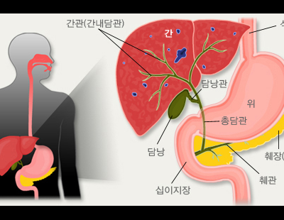 건강검진했더니 담낭에 혹이··· 서둘러 제거해야 할까