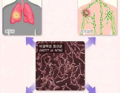 샤워기·사우나 통해 전파되는 ‘이 세균’··· 저체중 환자에게 더 위험한 이유 찾았다