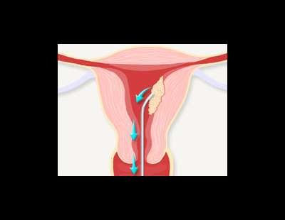 검사도 진단도 까다로운 ‘자궁내막암’··· 치료 효과 높일 암 유형 구분법 나왔다