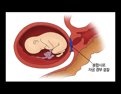 쌍둥이 조산 예방 위한 ‘이 수술’··· 오히려 조산 위험 높일 수도