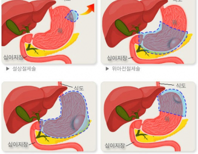 위암 수술 뒤 생기기 쉬운 영양결핍··· 장내 미생물 유형 따라 차이