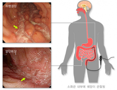 잦은 복통·설사로 다른 병과 혼동하기 쉬운 ‘크론병’··· 평생 관리가 중요